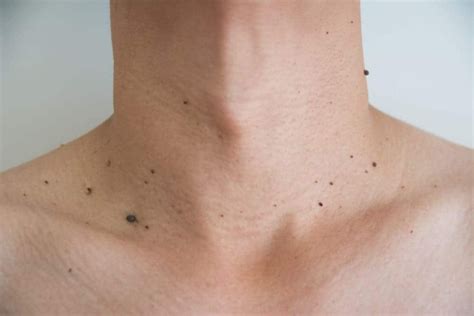 salicylic acid gamot sa kulugo|Uri ng Kulugo, Mga Dahilan, Senyales, At Lunas .